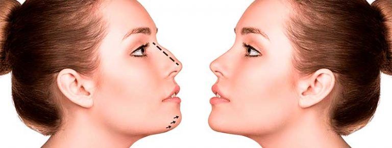 Perfiloplastia Sevilla | Aurea Clinic