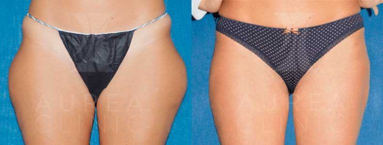 liposucción Sevilla Agualipo cartucheras
