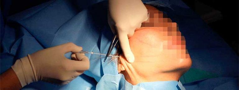 Hilos Tensores Lifting sin cirugía en Sevilla en Aurea Clinic