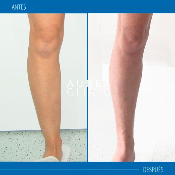lipedema sevilla
