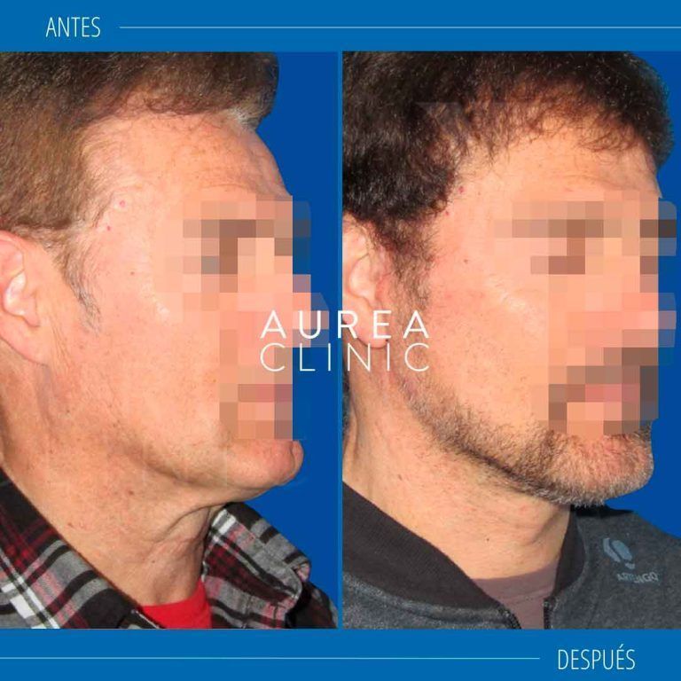 lifting cervicofacial sevilla