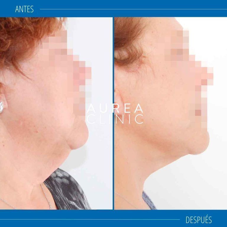 lifting cervicofacial sevilla