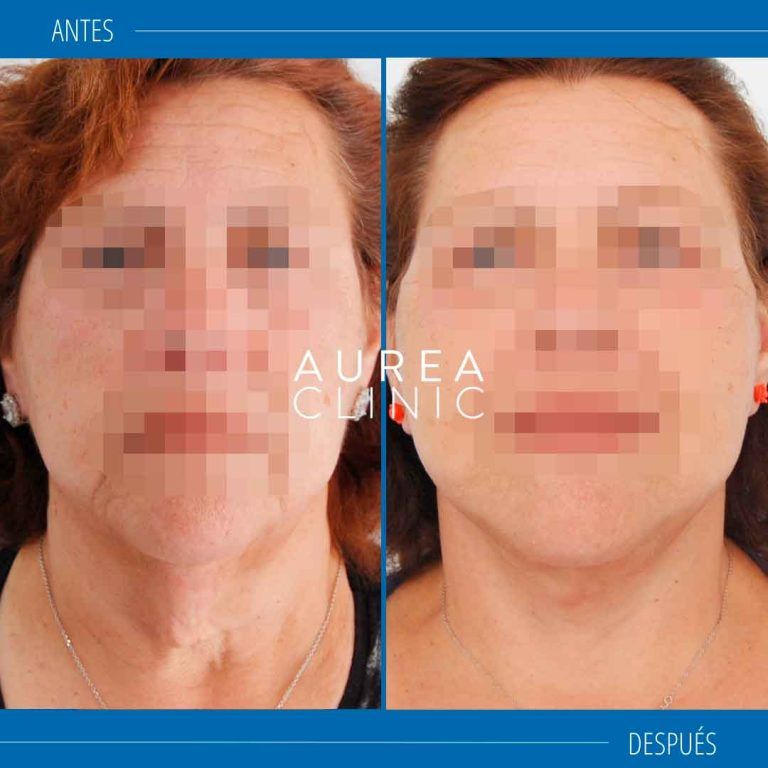 lifting cervicofacial sevilla