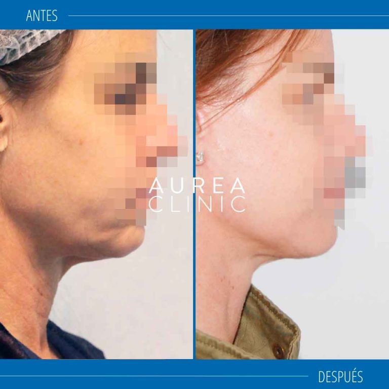 lifting cervicofacial sevilla