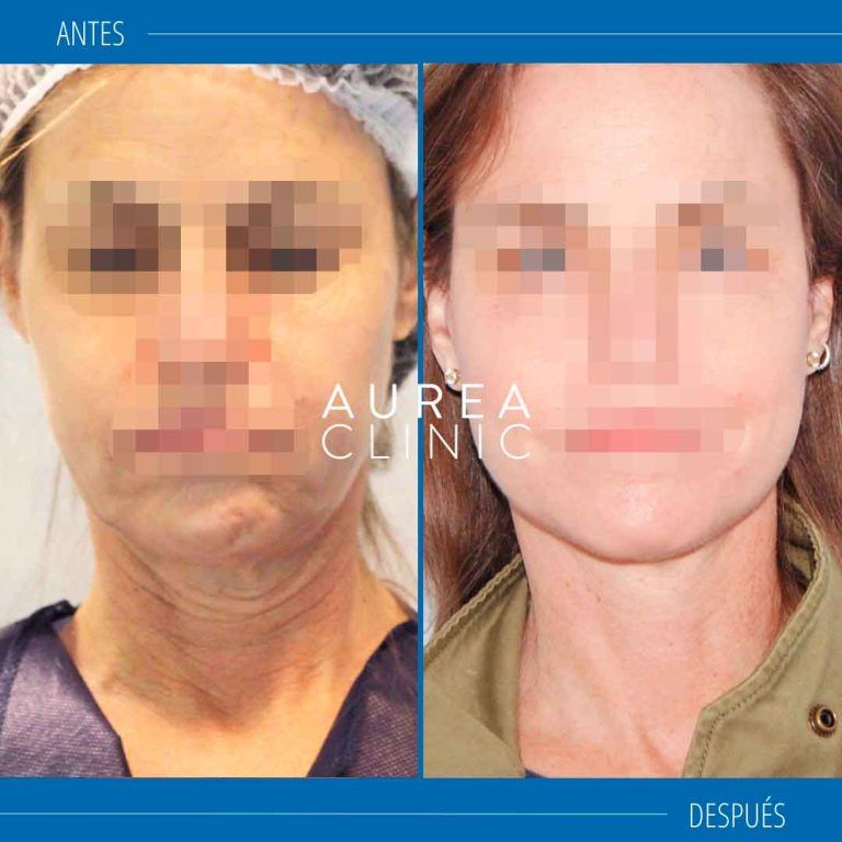lifting cervicofacial sevilla
