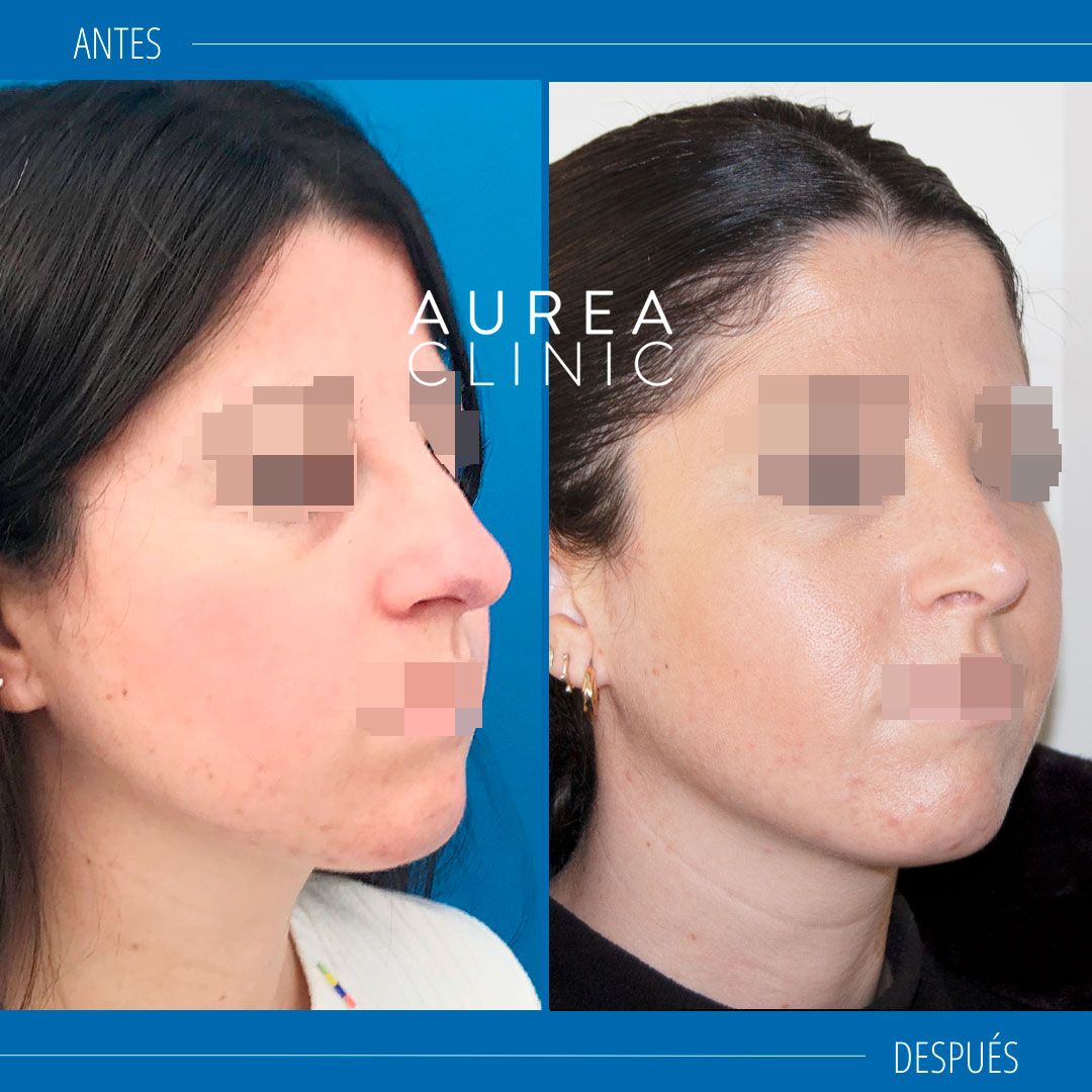 fotos Rinoplastia Doctora Martínez Padilla