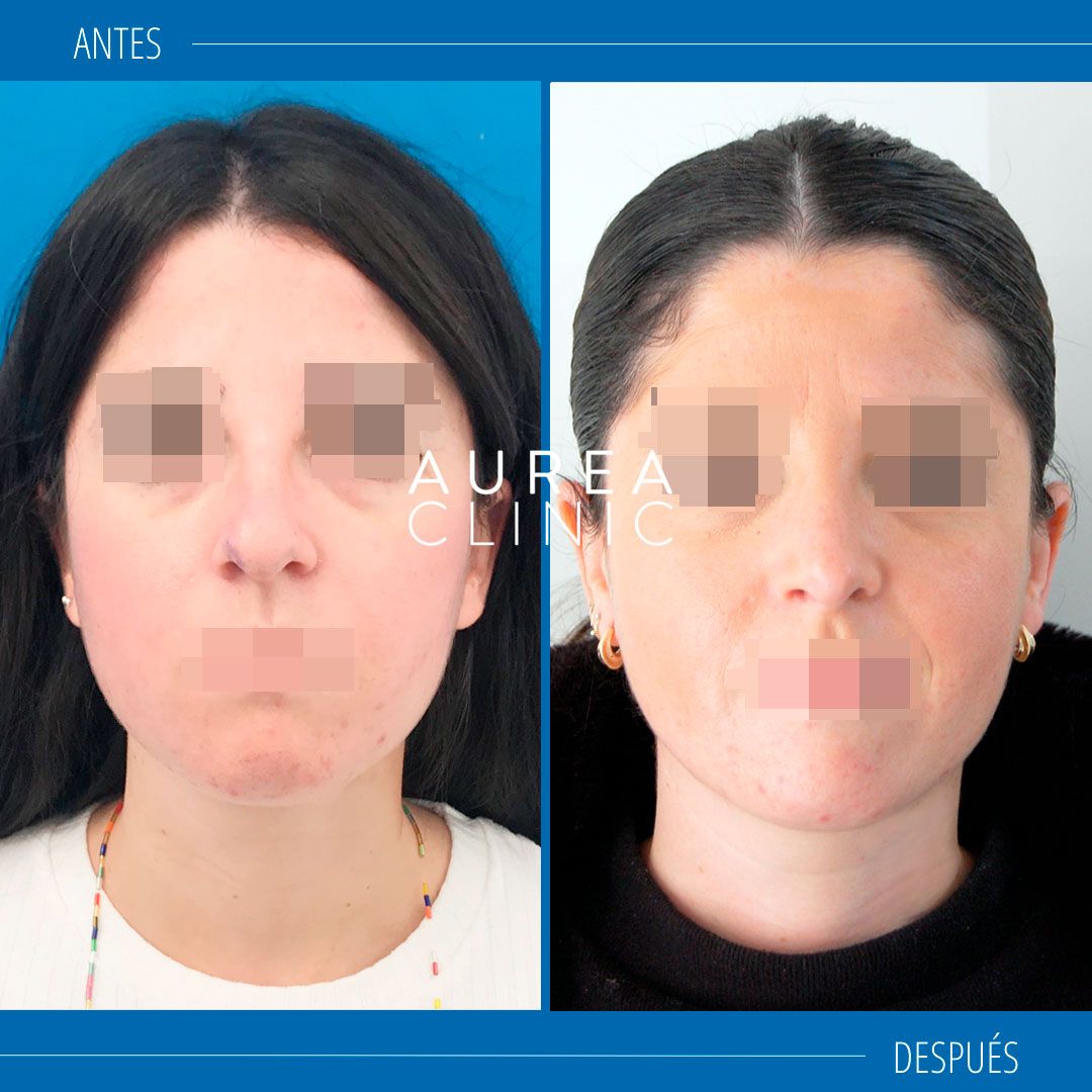 Rinoplastia Doctora Martínez Padilla fotos