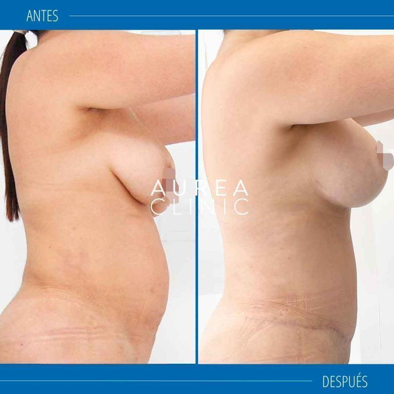 mommy makeover mastopexia abdominoplastia sevilla
