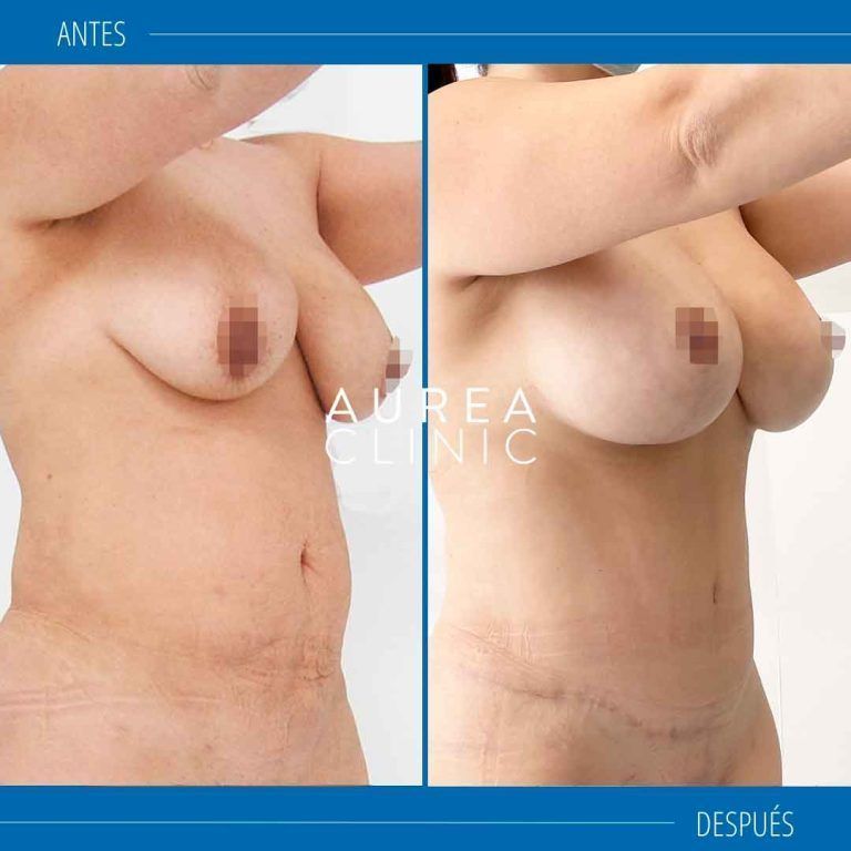 mommy makeover mastopexia abdominoplastia sevilla