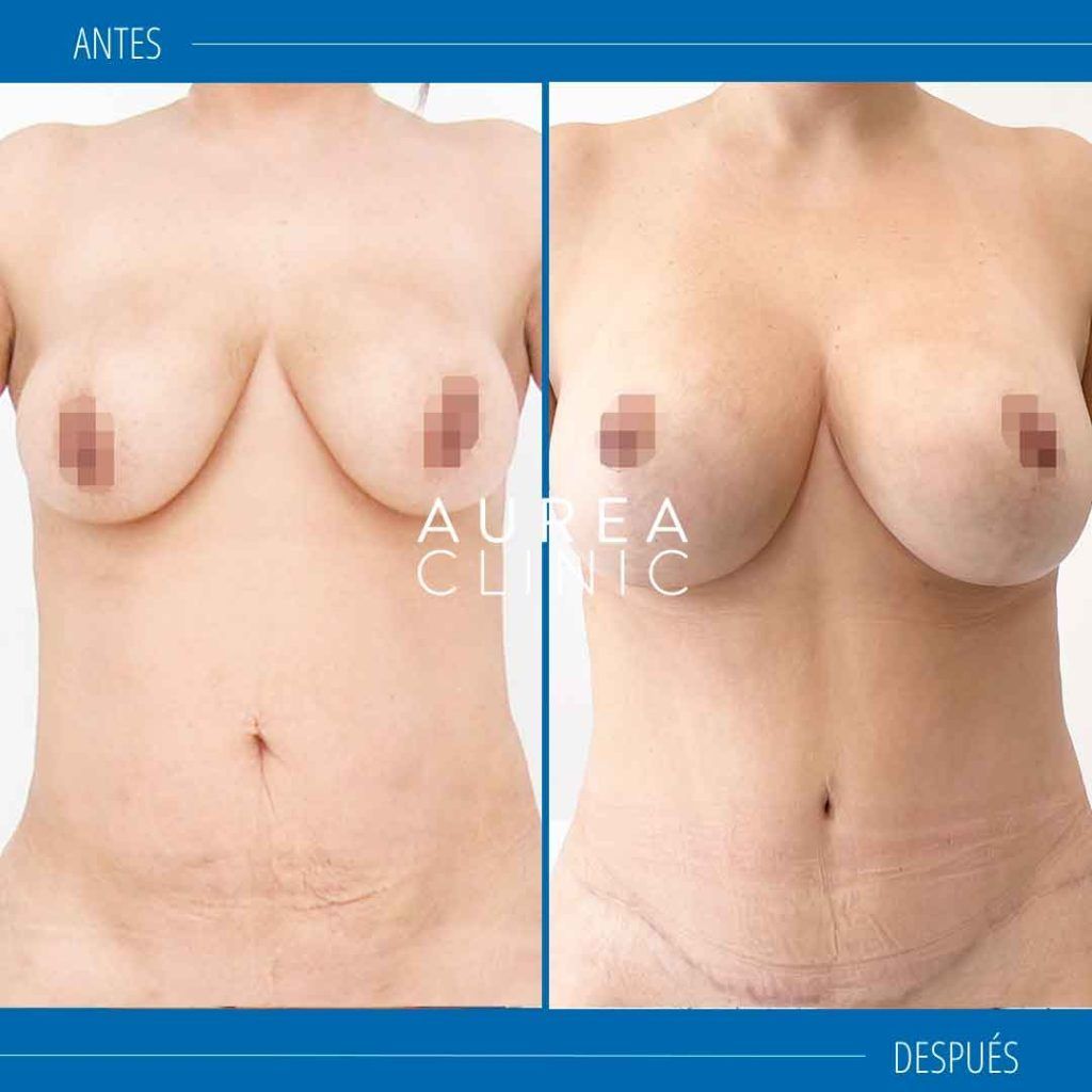 mommy makeover mastopexia abdominoplastia sevilla