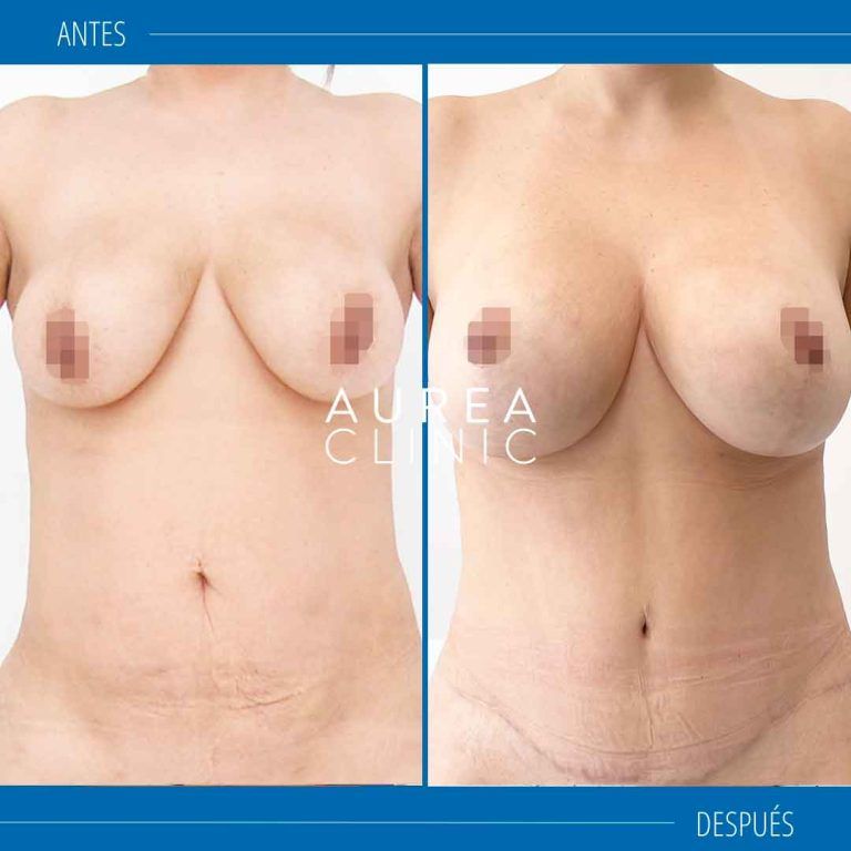 mommy makeover mastopexia abdominoplastia sevilla