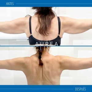 antes y después lifting de brazos o braquioplastia