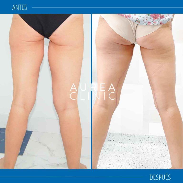 lifting de muslos antes y después Sevilla