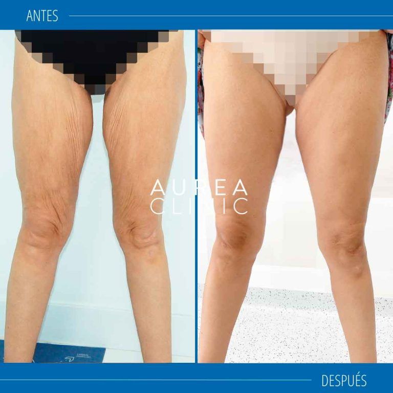 lifting de muslos o piernas antes y después Sevilla