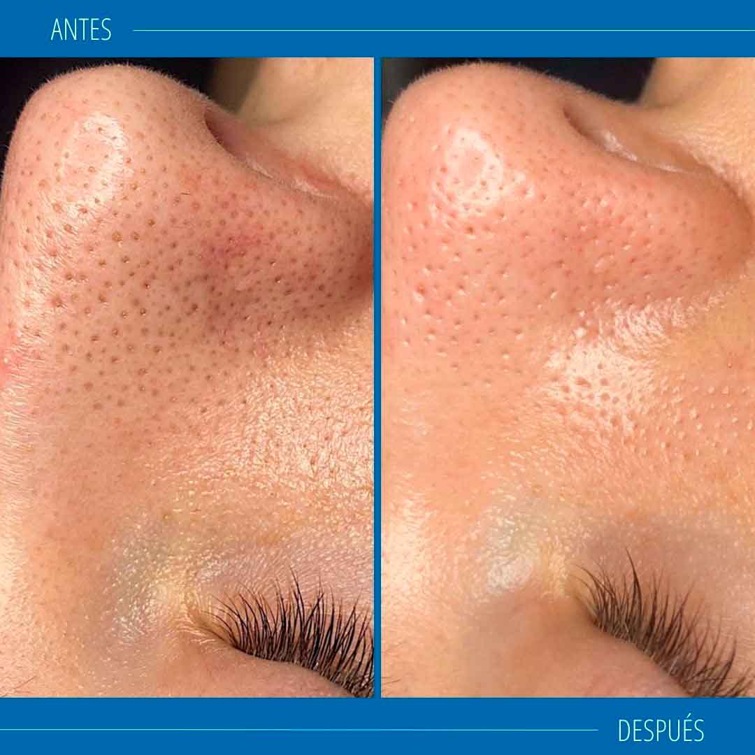 Hydrafacial antes y después