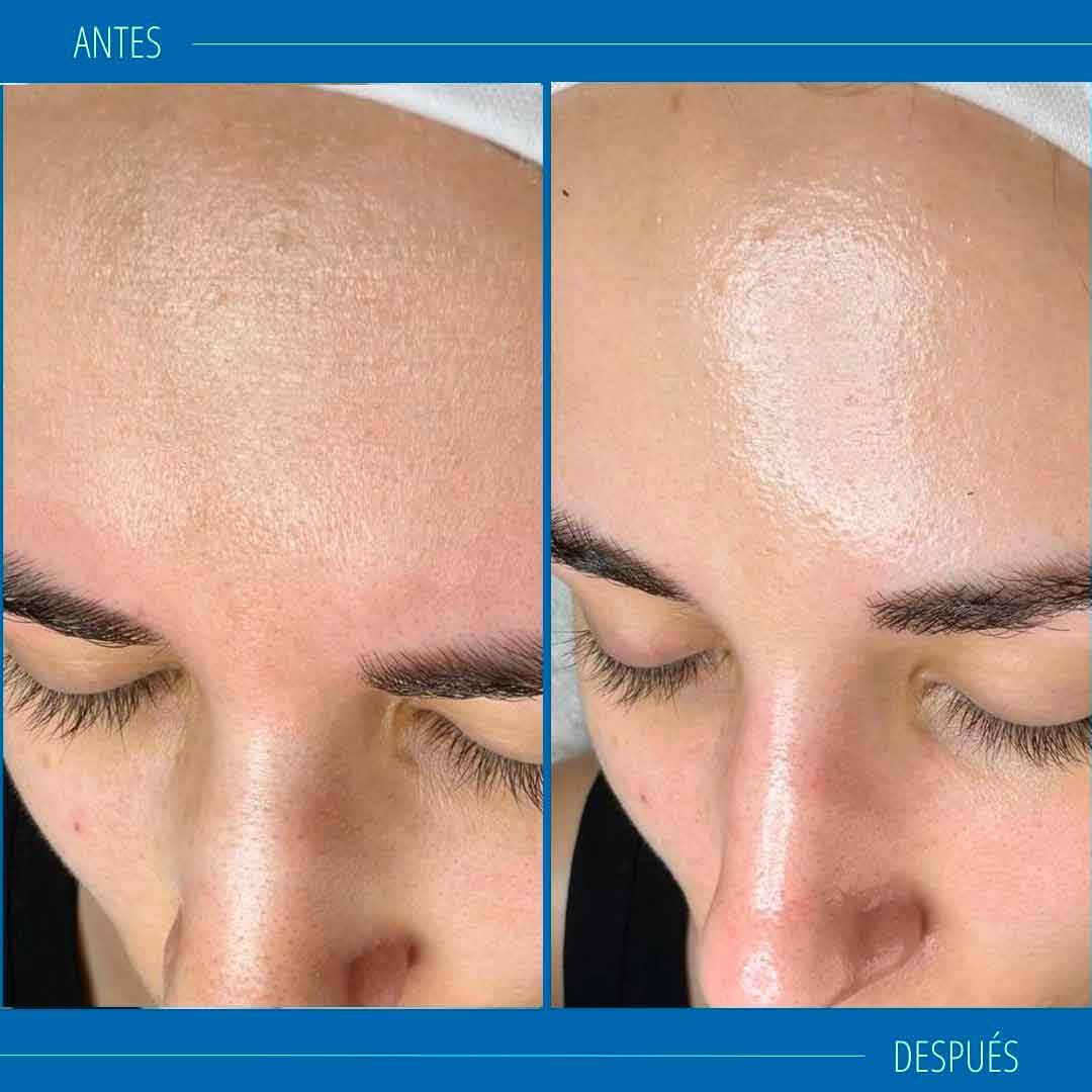 Hydrafacial profesional
