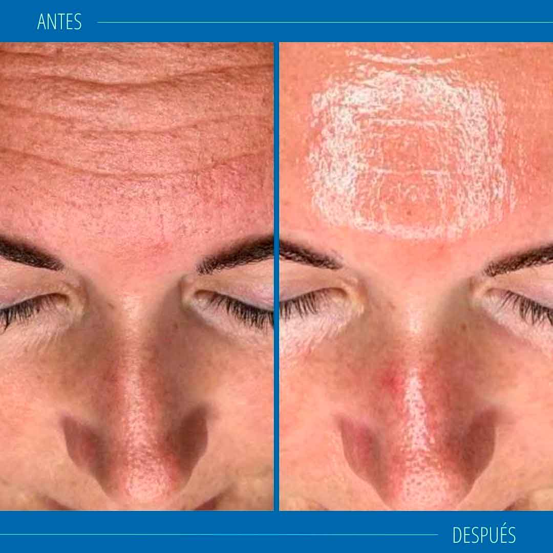 Hydrafacial resultados