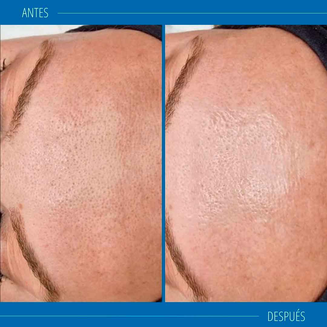 Hydrafacial Sevilla