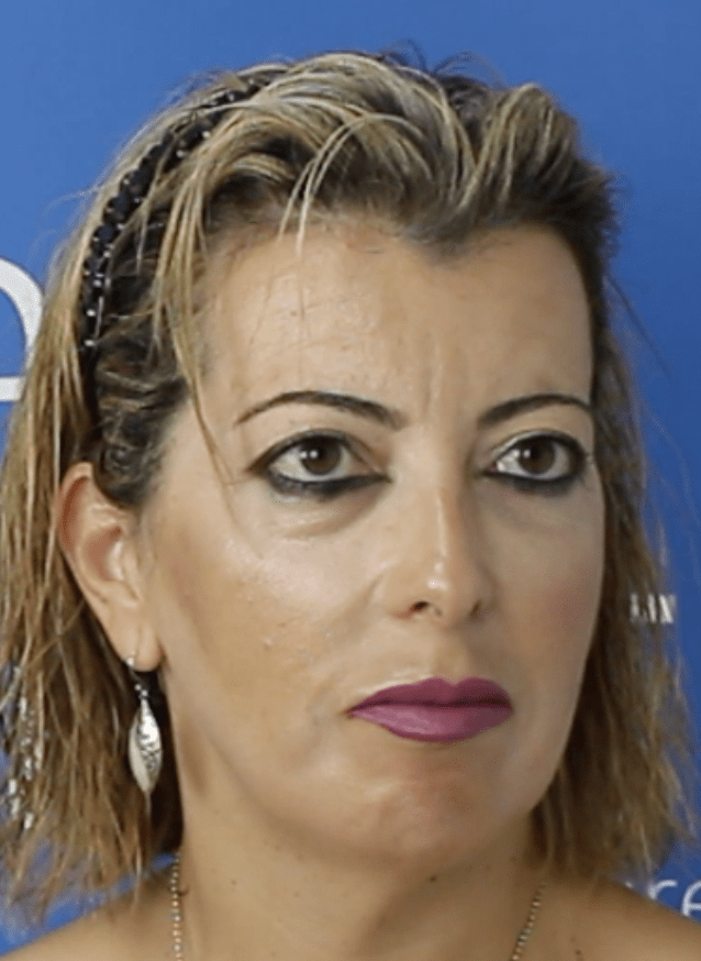 Testimonio de lipedema y cruroplastia