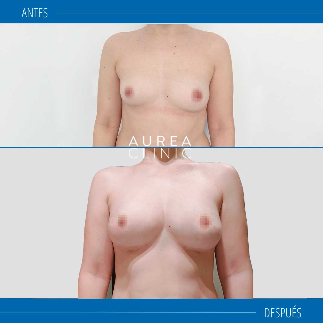 Lipoflling de mamas antes y después