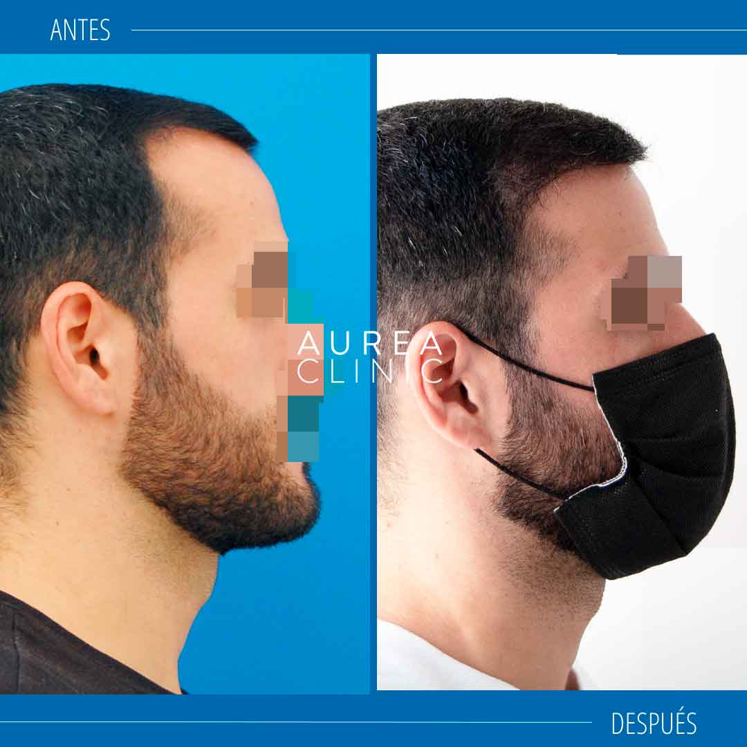 injerto-capilar-resultados-Aurea-Clinic-Sevilla