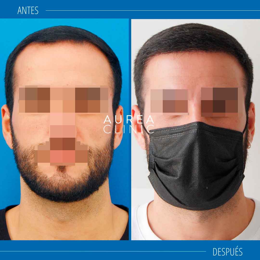 injerto-capilar-resultados