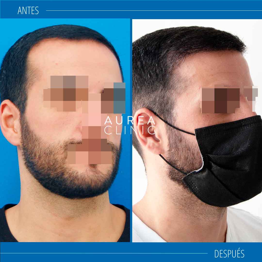 injertos-capilar-resultados-Aurea-Clinic