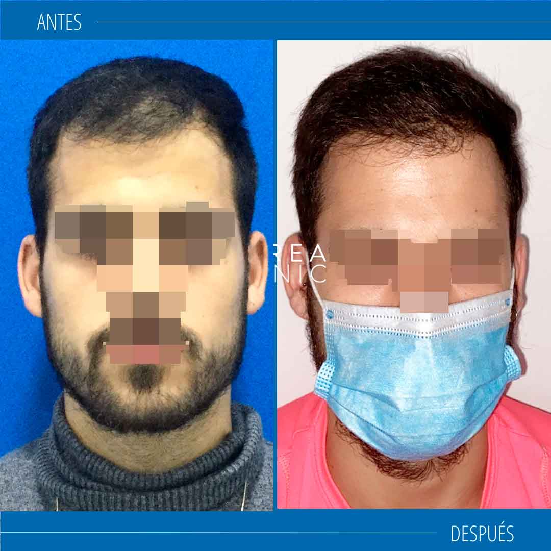trasplante-capilar-resultado