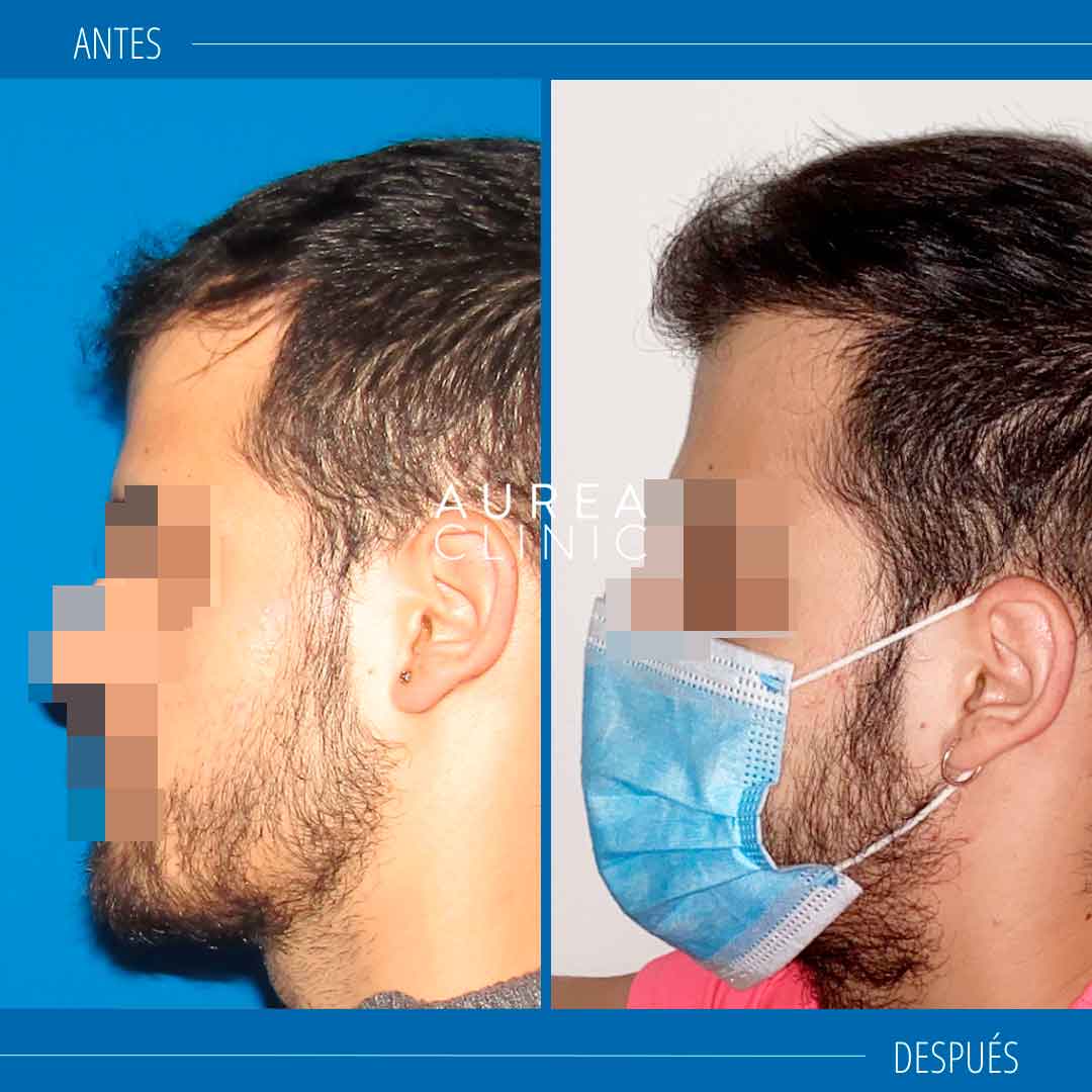 trasplante-capilar-resultados-Aurea-Clinic-Sevilla