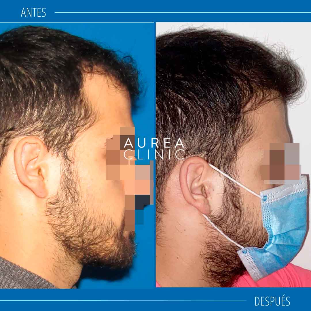 trasplante-capilar-resultados-Aurea-Clinic