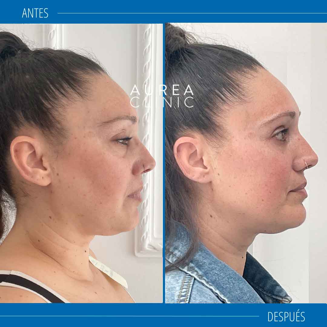 Blefaroplastia inferior antes y después Aurea Clinic