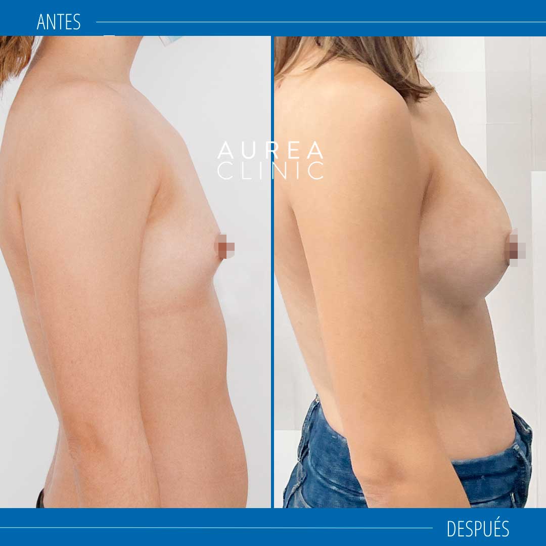 Preservé antes y después Aurea Clinic