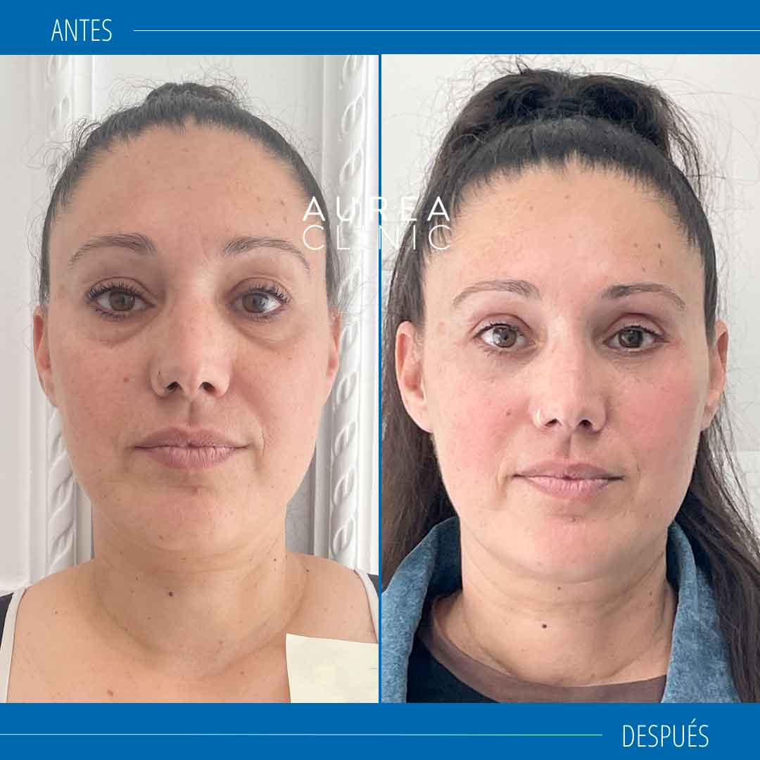 Blefaroplastia antes y después