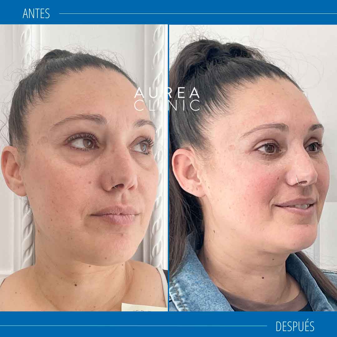 Blefaroplastia inferior antes y después