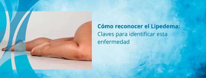 ¿Cómo identificar la enfermedad de Lipedema?