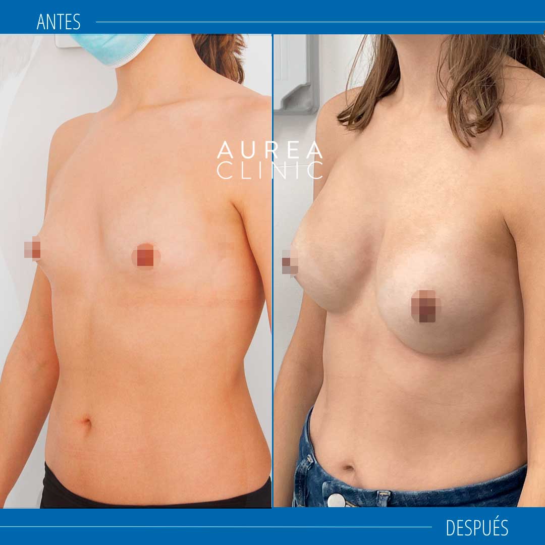 Preservé casos antes y después