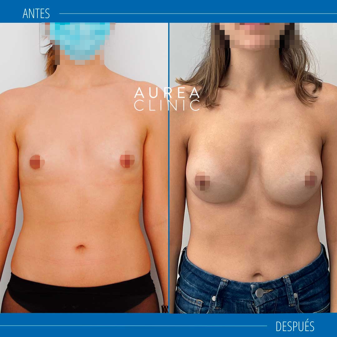 Preservé antes y después