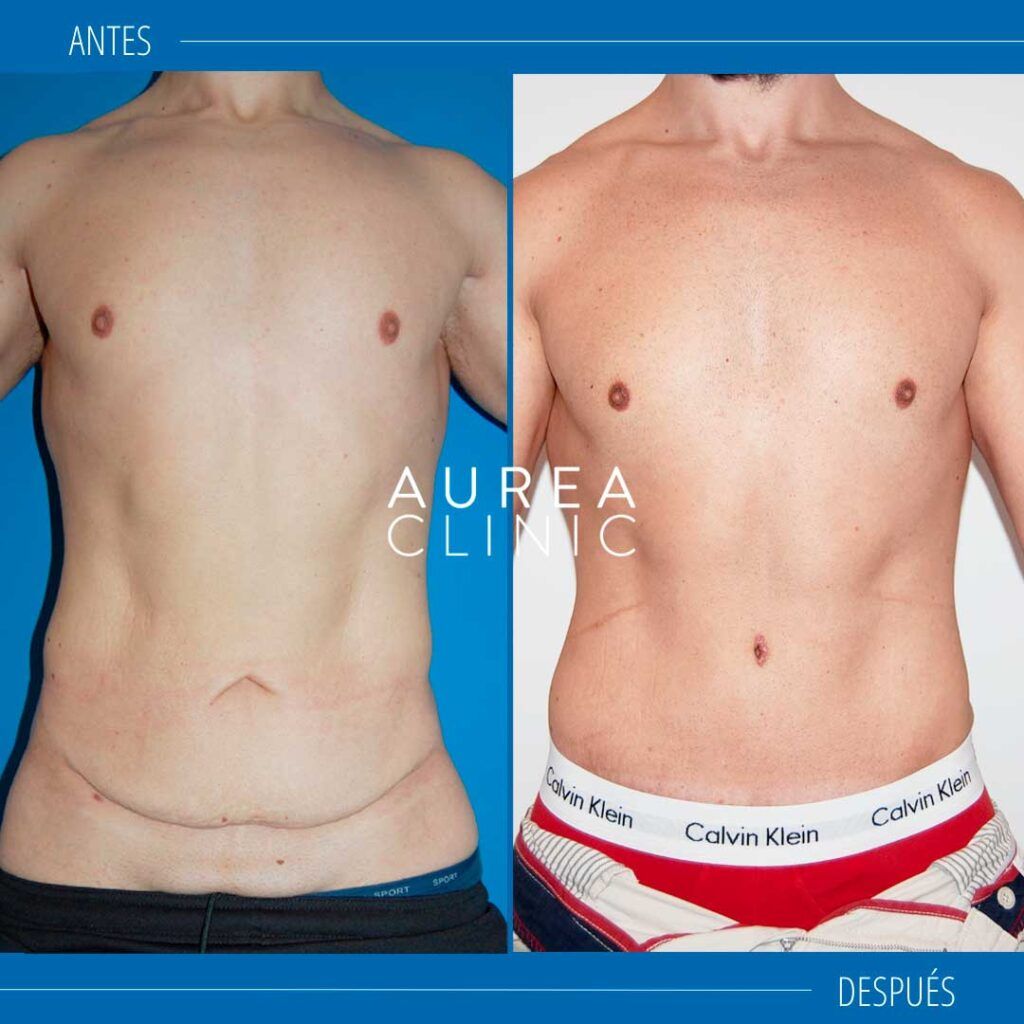 abdominoplastia Aurea Clinic