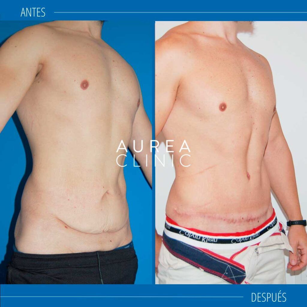 abdominoplastia masculina Aurea Clinic