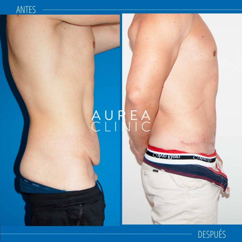 cirugía de abdomen abdominoplastia Aurea Clinic