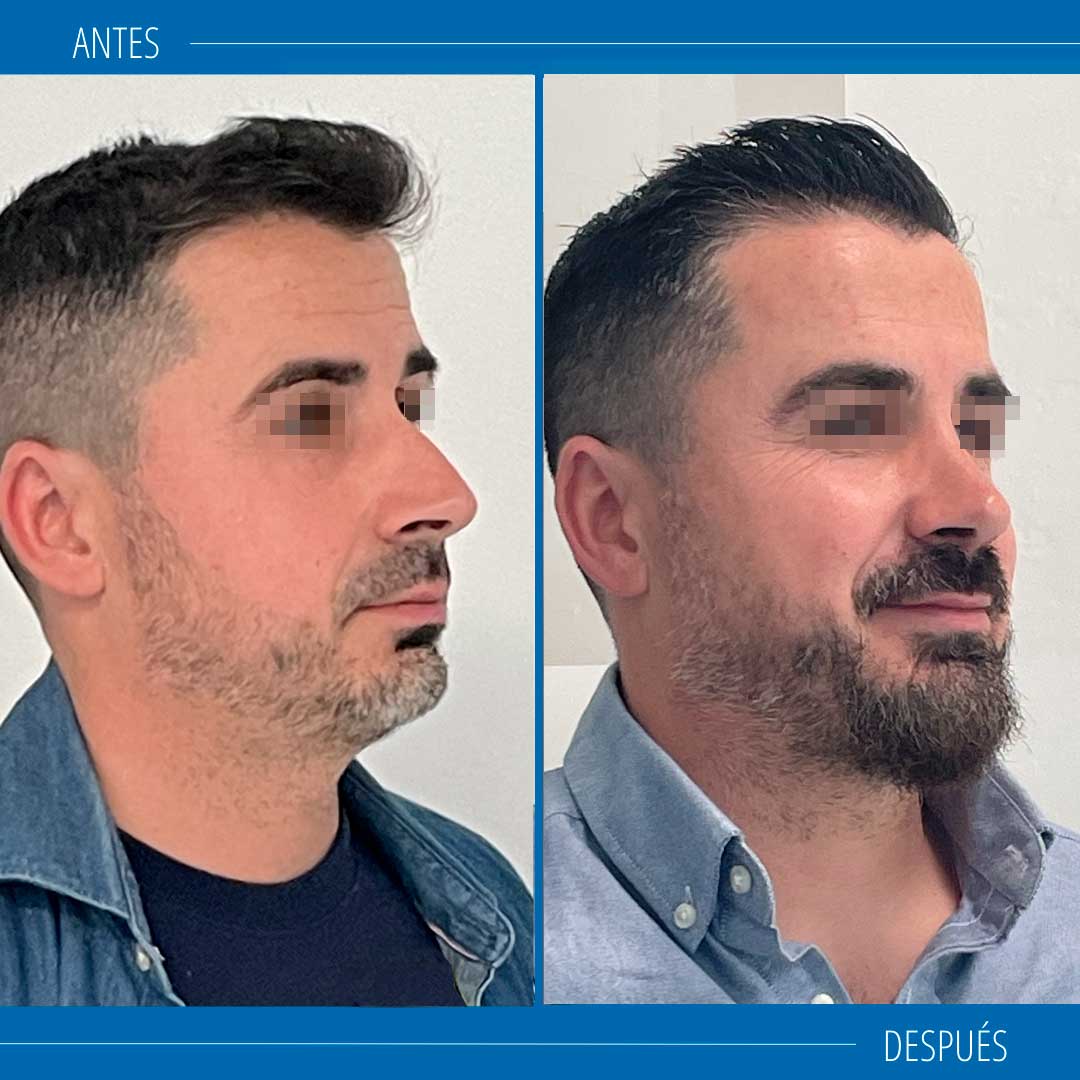 rinoplastia en hombres