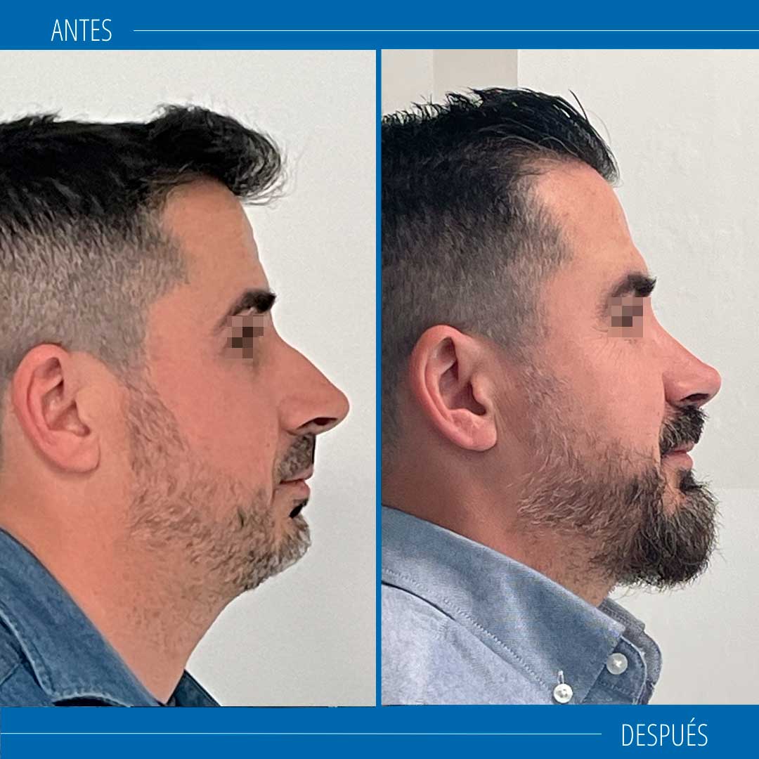 rinoplastia masculina
