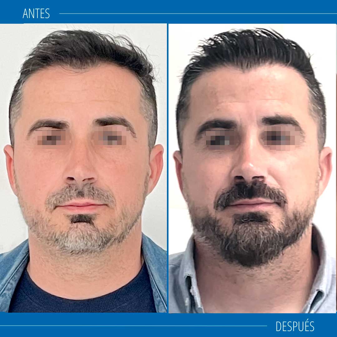 rinoplastia ultrasonica hombres