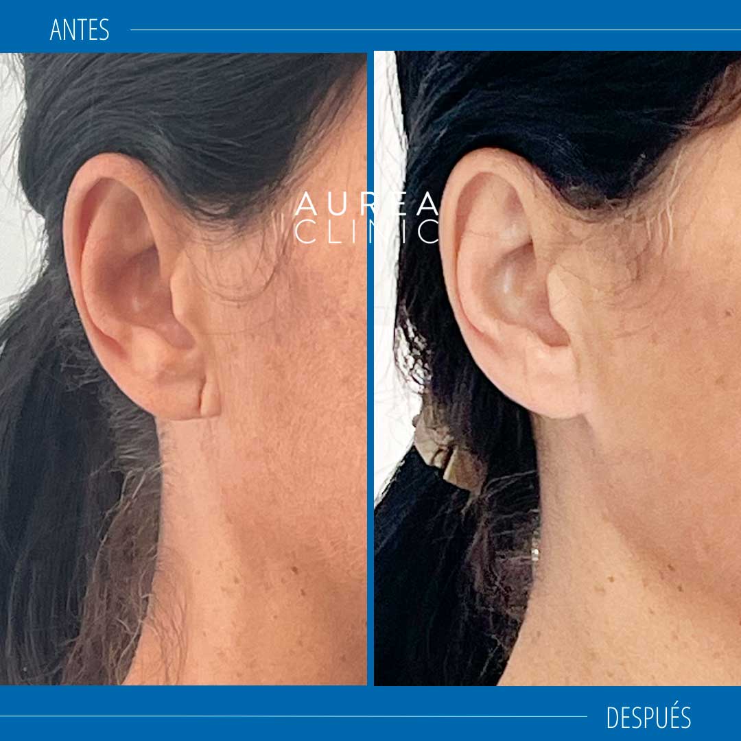 antes y después cirugía del lóbulo