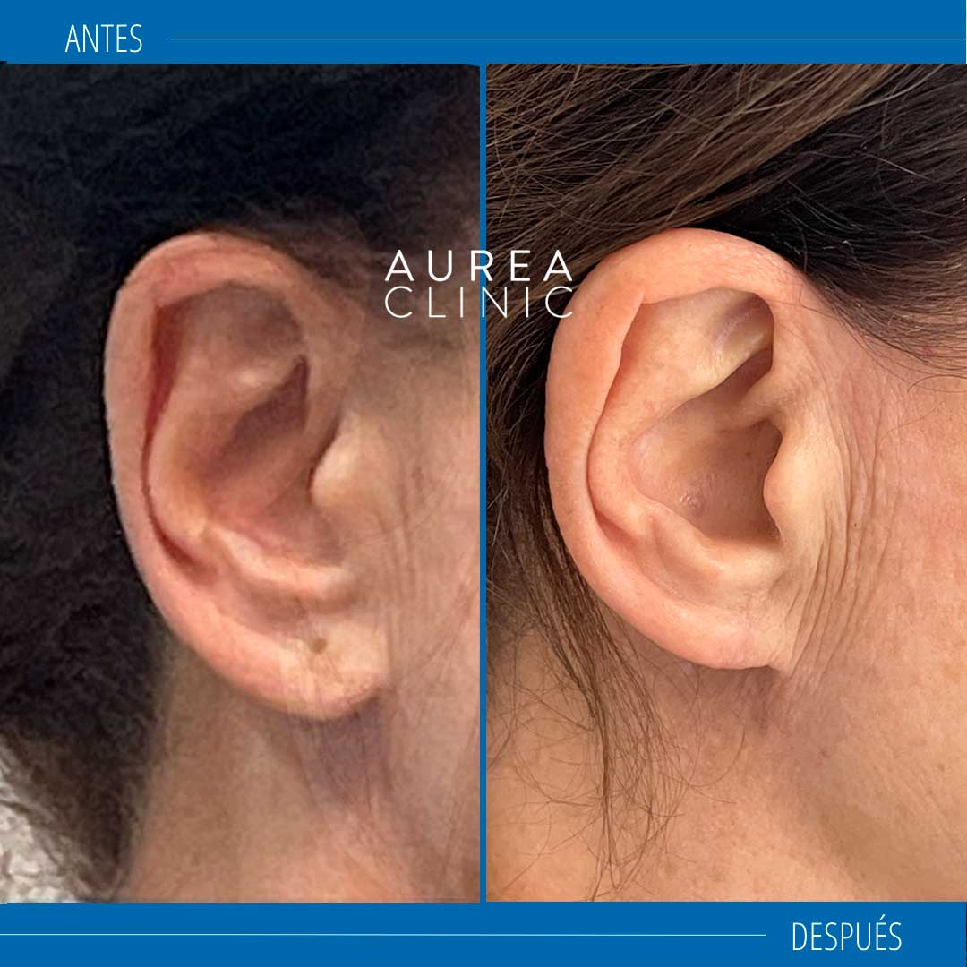 lobuloplastia antes y después
