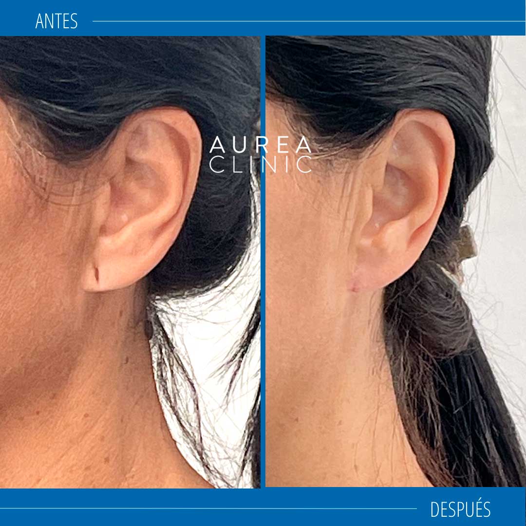antes y después lobuloplastia
