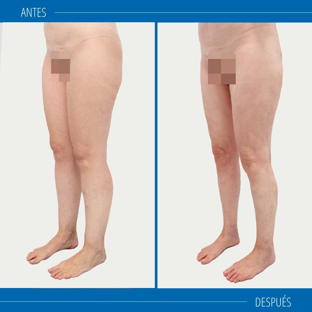 lipedema fotos antes y después