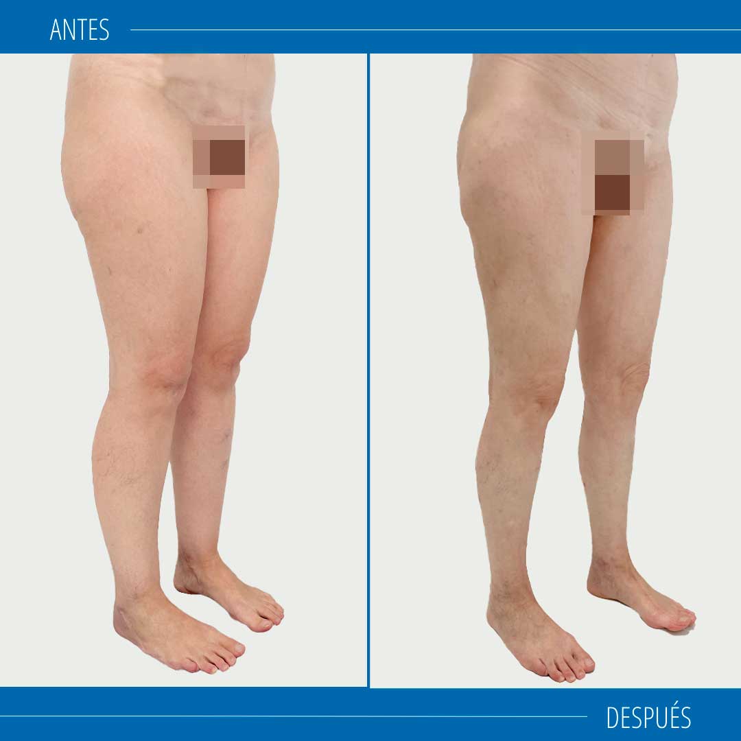 lipedema fotos resultados