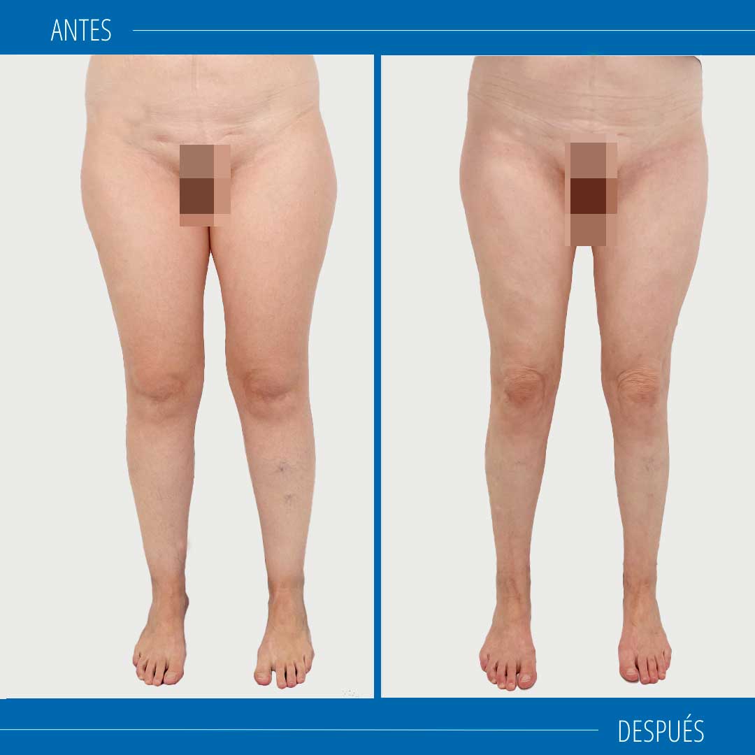 Lipedema fotos