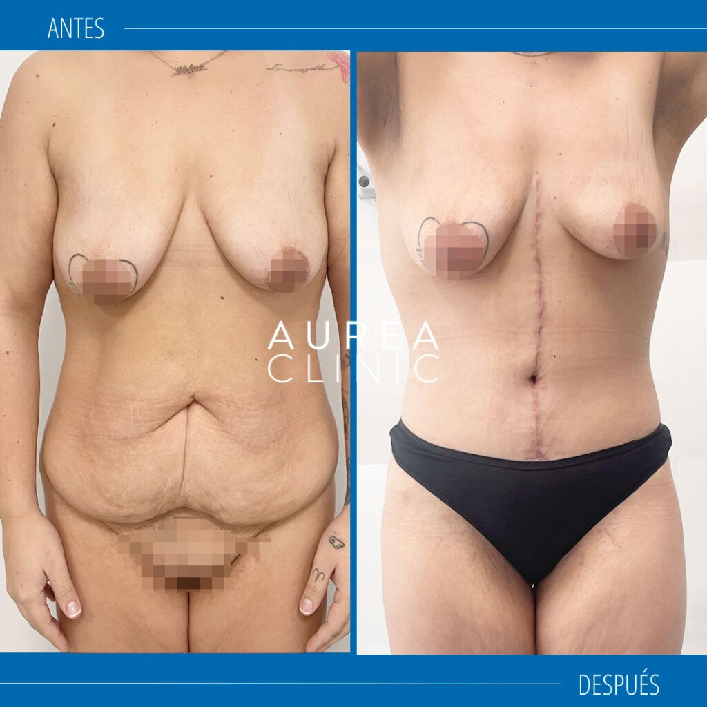 abdominoplastia circunferencial